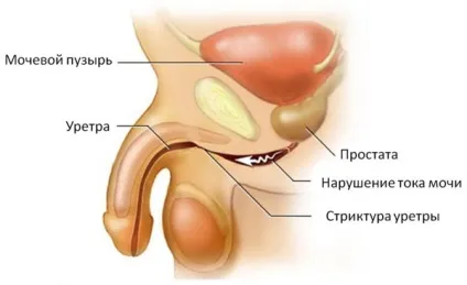 Неінфекційний уретрит причини виникнення та способи лікування (причини) Неінфекційний уретрит причини виникнення та способи лікування