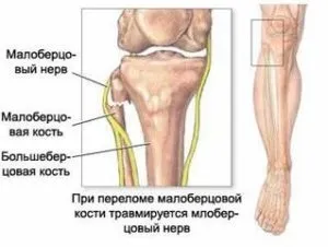 Неврит малогомілкового нерва симптоми і лікування (малоберцового) Неврит малогомілкового нерва симптоми і лікування