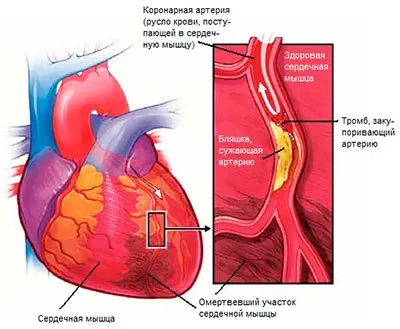Ниючий біль в області серця причини і можливі захворювання (області) Ниючий біль в області серця причини і можливі захворювання