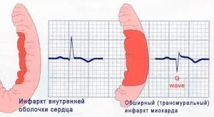 Великий (трансмуральний) інфаркт міокарда симптоми, лікування, профілактика, причини (профілактика) Великий (трансмуральний) інфаркт міокарда симптоми, лікування, профілактика, причини