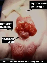 Екстрофія сечового міхура, мій уролог (екстрофія) Екстрофія сечового міхура, мій уролог