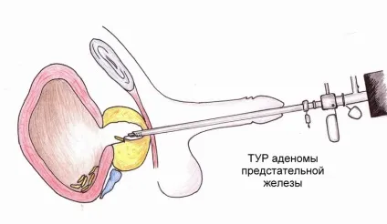 Ендоурології методи малоінвазивного лікування (каменю літоекстракція видалення каменю) Ендоурології методи малоінвазивного лікування
