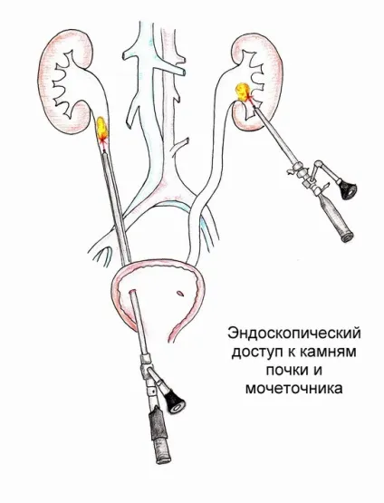 Ендоурології методи малоінвазивного лікування (контактна дроблення каменя) Ендоурології методи малоінвазивного лікування