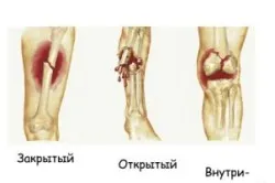 Операції на нозі види хірургії нижніх кінцівок (відео) (операції) Операції на нозі види хірургії нижніх кінцівок (відео)