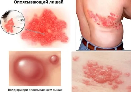 Оперізуючий лишай лікування в домашніх умовах народними засобами (лікування) Оперізуючий лишай лікування в домашніх умовах народними засобами