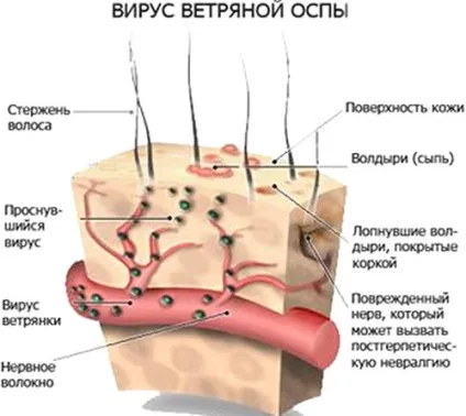 Оперізуючий лишай лікування в домашніх умовах народними засобами (лікування) Оперізуючий лишай лікування в домашніх умовах народними засобами