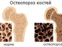 Остеопорозу тазостегнового суглоба симптоми і лікування (тазостегновий) Остеопорозу тазостегнового суглоба симптоми і лікування