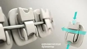 Ортодонтія, брекети