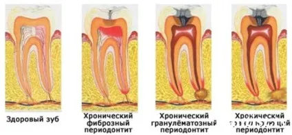 Особливості лікування хронічного періодонтиту в стадії загострення (лікування) Особливості лікування хронічного періодонтиту в стадії загострення