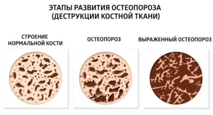 Остеопороз тазостегнового суглоба симптоми і лікування (симптоми) Остеопороз тазостегнового суглоба симптоми і лікування