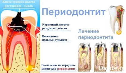 Особливості лікування хронічного періодонтиту в стадії загострення (періодонтиту) Особливості лікування хронічного періодонтиту в стадії загострення