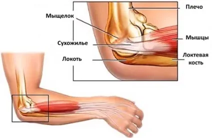 Остеоартроз ліктьового суглоба 1, 2 і 3-го ступеня лікування (ступеня) Остеоартроз ліктьового суглоба 1, 2 і 3-го ступеня лікування