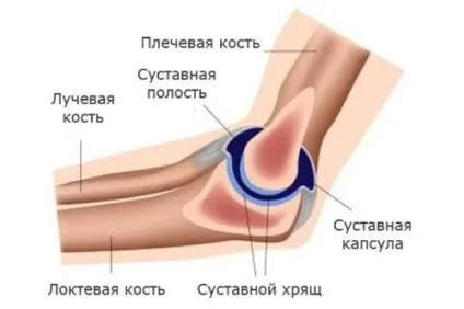 Остеоартроз ліктьового суглоба 1, 2 і 3-го ступеня лікування (суглоба) Остеоартроз ліктьового суглоба 1, 2 і 3-го ступеня лікування