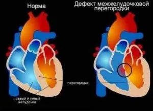 Відхилення електричної осі серця вправо (вправо) Відхилення електричної осі серця вправо