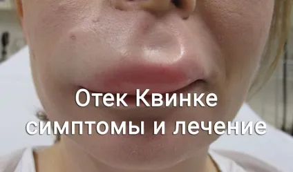Набряк Квінке симптоми, лікування і дієві народні засоби (лікування) Набряк Квінке симптоми, лікування і дієві народні засоби