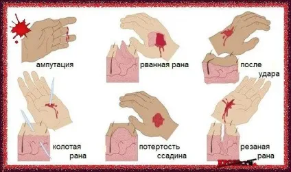 Відкрита рана - лікування кровотеч (виникають відкриті рани) Відкрита рана - лікування кровотеч