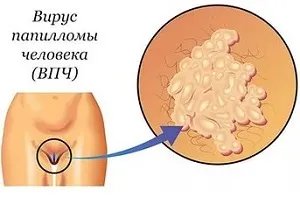 Папіломи в гінекології що це таке, симптоми і лікування