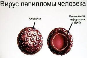 Папіломи в гінекології що це таке, симптоми і лікування