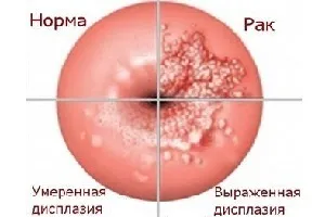 Папіломи в гінекології що це таке, симптоми і лікування