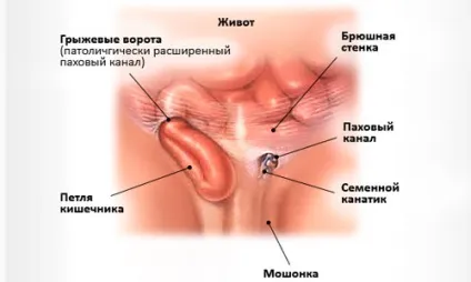 Пахова грижа у чоловіків реабілітація після операції, ускладнення