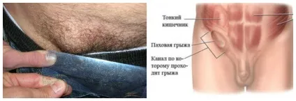 Період після операції з видалення пахової грижі (пахової) Період після операції з видалення пахової грижі