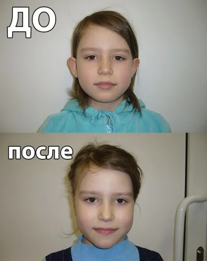 Пластика вуха коригуємо вроджені вади (пластика) Пластика вуха коригуємо вроджені вади