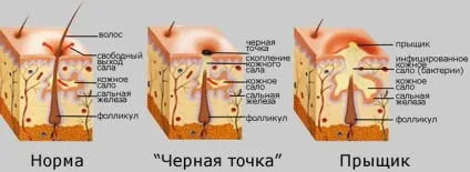 Чому перед місячними з'являються прищі на обличчі, як цьому запобігти (профілактика) Чому перед місячними з'являються прищі на обличчі, як цьому запобігти