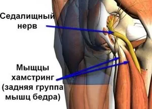 Допомога при защемленні сідничного нерва в домашніх умовах симптоми і лікування (затисканні) Допомога при защемленні сідничного нерва в домашніх умовах симптоми і лікування