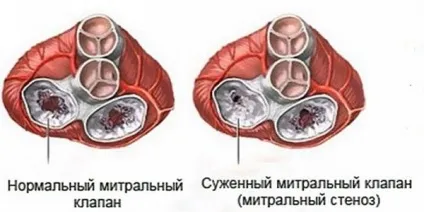 Пороки мітрального клапана серця класифікація, діагностика і лікування (пороки) Пороки мітрального клапана серця класифікація, діагностика і лікування