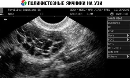 Полікістоз яєчників причини, симптоми, діагностика та лікування синдрому полікістозних яєчників