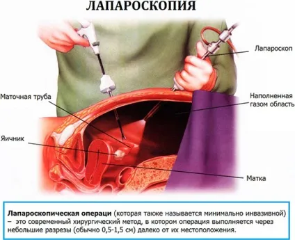 Полікістоз яєчників причини, симптоми, діагностика та лікування синдрому полікістозних яєчників