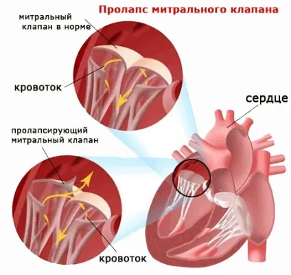 Пороки мітрального клапана серця класифікація, діагностика і лікування (серця) Пороки мітрального клапана серця класифікація, діагностика і лікування