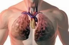1, 2, 3 і 4 ступінь опіку, ознаки та симптоми (ступінь) 1, 2, 3 і 4 ступінь опіку, ознаки та симптоми