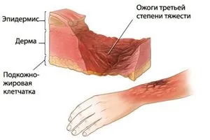 1, 2, 3 і 4 ступінь опіку, ознаки та симптоми (розвитку опікової хвороби) 1, 2, 3 і 4 ступінь опіку, ознаки та симптоми