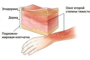 1, 2, 3 і 4 ступінь опіку, ознаки та симптоми (розвитку опікової хвороби) 1, 2, 3 і 4 ступінь опіку, ознаки та симптоми