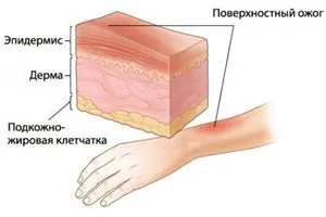 1, 2, 3 і 4 ступінь опіку, ознаки та симптоми (розвитку опікової хвороби) 1, 2, 3 і 4 ступінь опіку, ознаки та симптоми