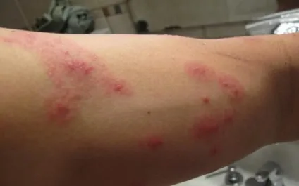 Постільні блохи укуси на фото, симптоми і способи боротьби (постільні) Постільні блохи укуси на фото, симптоми і способи боротьби