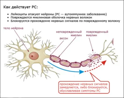 Наслідки розсіяного склерозу - чим загрожує хвороба і небезпеки (небезпеки) Наслідки розсіяного склерозу - чим загрожує хвороба і небезпеки