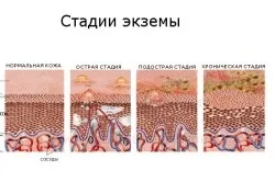 причини екземи