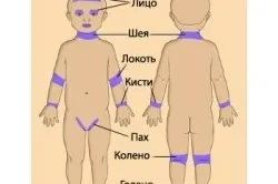 причини екземи