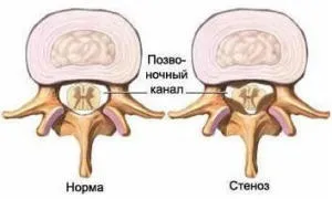 Причини, симптоми і лікування стенозу хребетного каналу поперекового і шийного відділу (симптоми лікування вторинний таке відносний стеноз хребетного каналу рівні поперекового шийного відділу) Причини, симптоми і лікування стенозу хребетного каналу поперекового і шийного відділу
