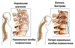 Причини, симптоми і лікування стенозу хребетного каналу поперекового і шийного відділу (симптоми) Причини, симптоми і лікування стенозу хребетного каналу поперекового і шийного відділу