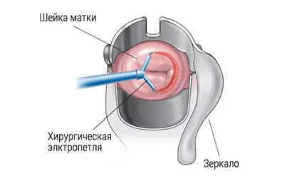 Причини і лікування ерозії шийки матки (лікування) Причини і лікування ерозії шийки матки
