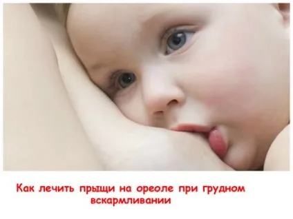 Прищі на сосках причини виникнення та лікування (каналі волосяного фолікула) Прищі на сосках причини виникнення та лікування
