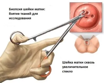 Причини і лікування ерозії шийки матки (ерозії) Причини і лікування ерозії шийки матки