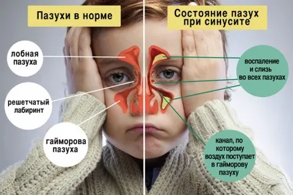 Промивання носа при гаймориті - як правильно полоскати гайморові пазухи (як вилікувати гайморит за допомогою медикаментозної і апаратної терапії.) Промивання носа при гаймориті - як правильно полоскати гайморові пазухи