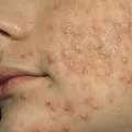 Бульбашки на обличчі