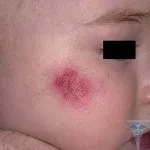 Бульбашки на обличчі