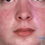 Бульбашки на обличчі
