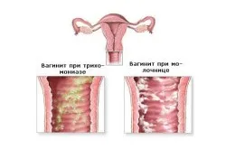 Протизапальні свічки в гінекології